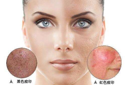 毛孔粗大痘印痘坑修复的护肤方法,有痘印痘坑怎么用护肤品消除