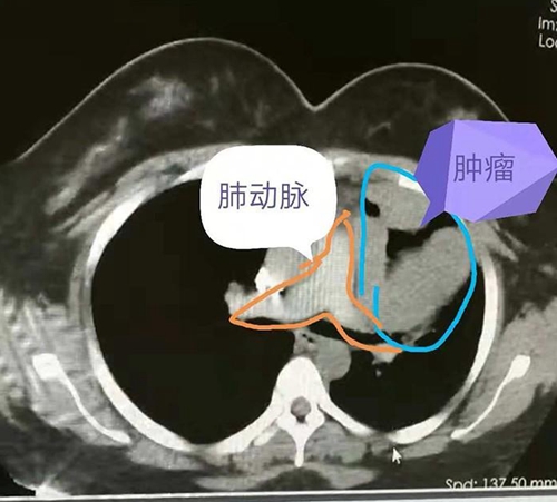年纪大的恶性胸腺瘤建议做手术吗,30多岁胸腺瘤影响生命