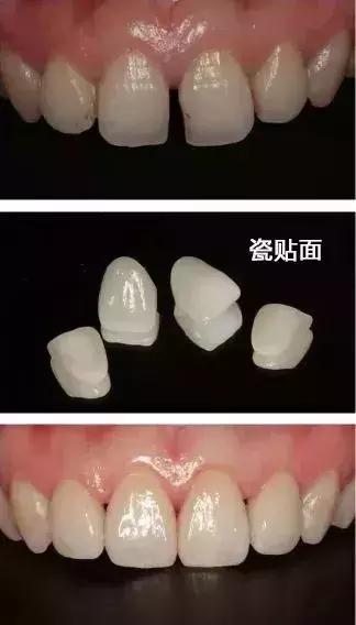 牙缝很大很深能补吗,小的牙缝可以补吗