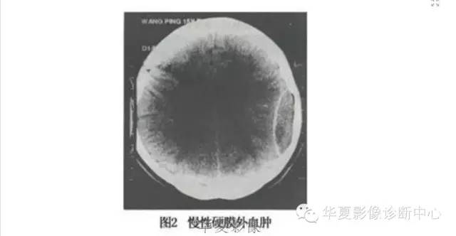 一文读懂颅内胆脂瘤,一文看懂背后的真相