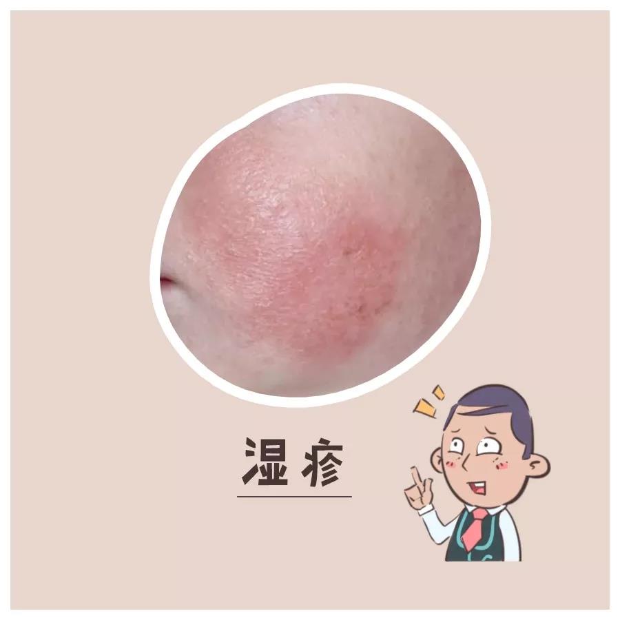 天热起痱子怎么能去根,天热痱子用什么药材治呢