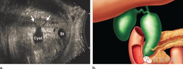胎儿卵巢囊肿5.6厘米会消失吗,卵巢巨大囊肿与妊娠鉴别