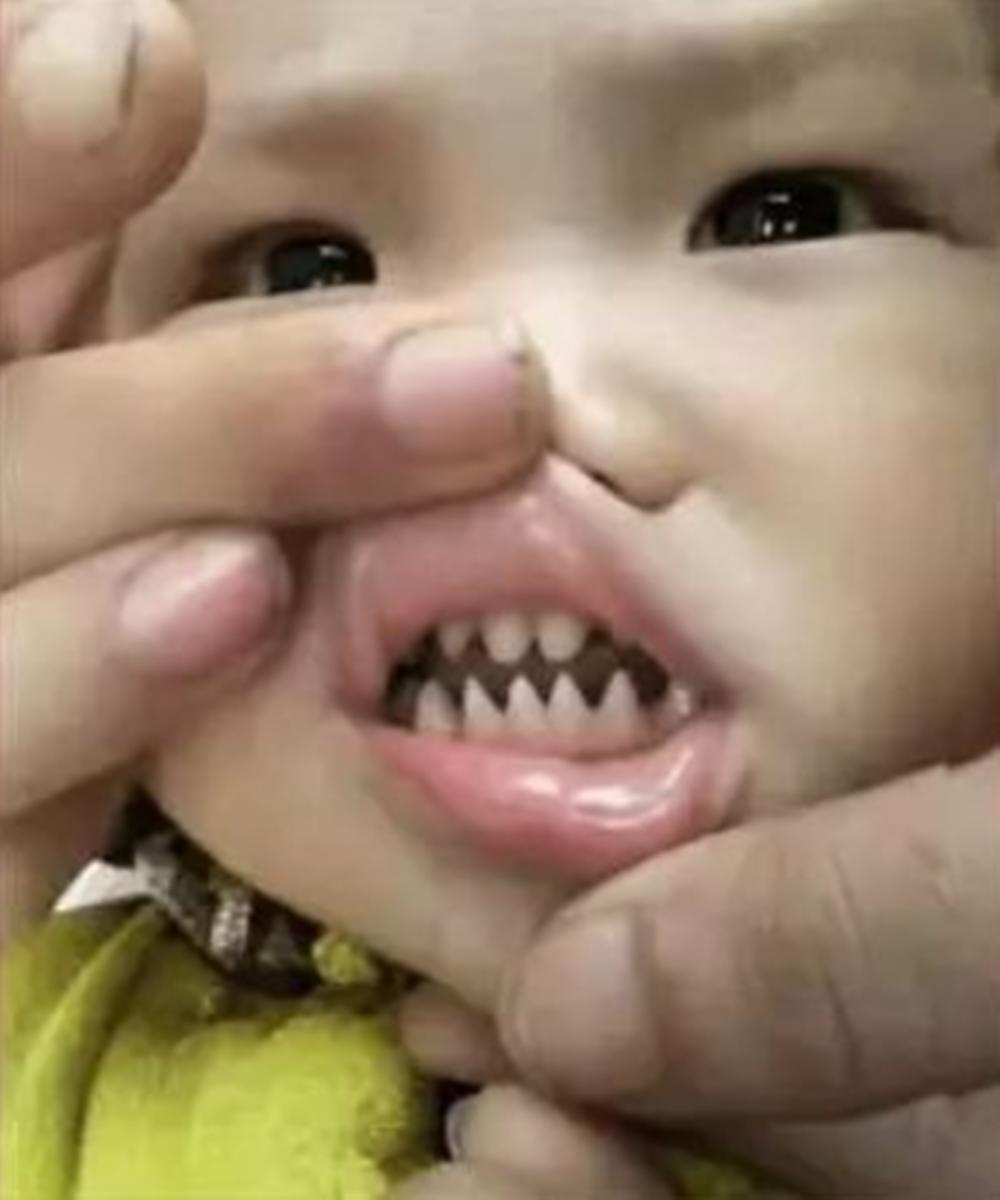 宝宝牙齿怎么长成鲨鱼牙,儿童口腔问题鲨鱼牙