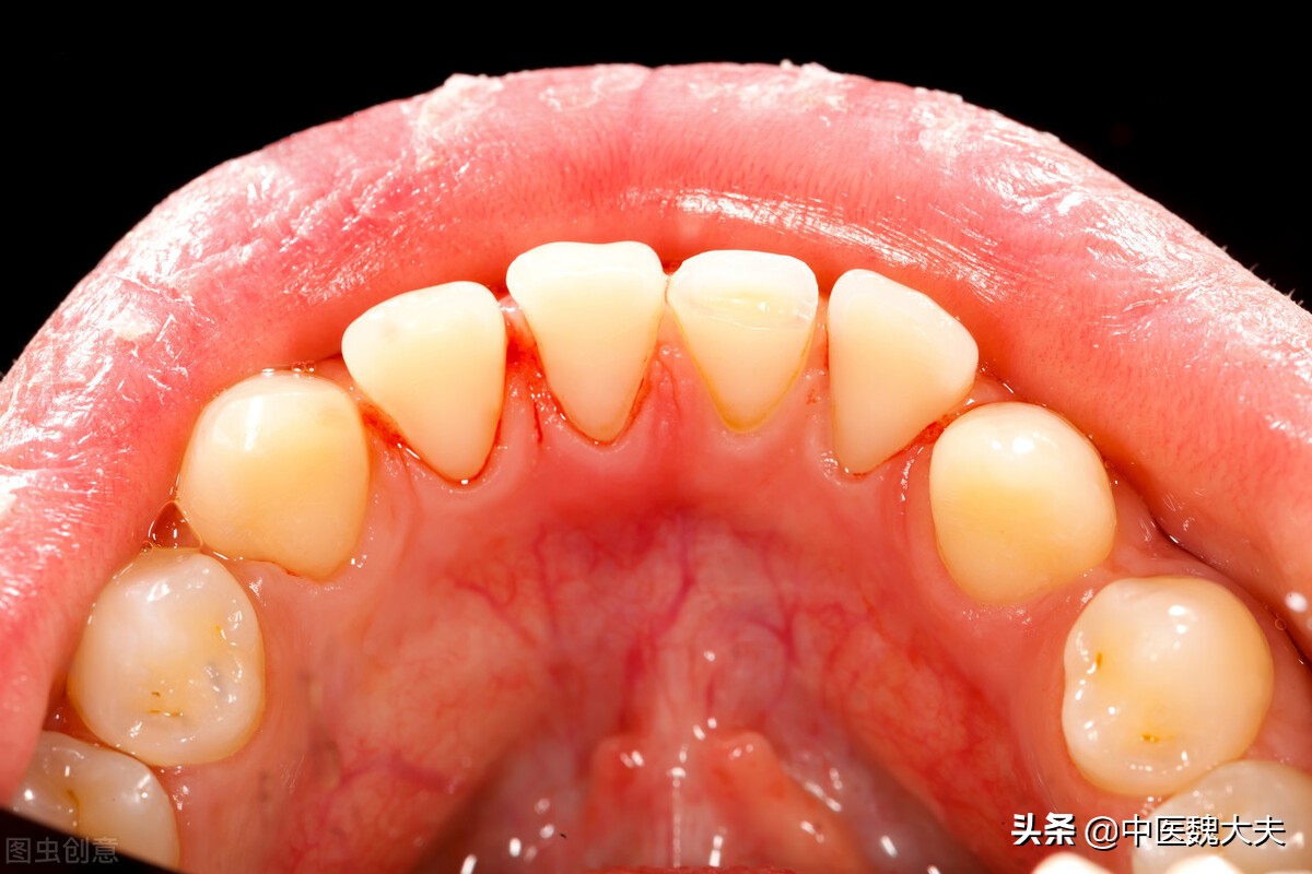 牙龈出血中医的解决方法,牙龈出血鼻出血是什么原因引起的