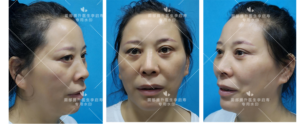 经常耷拉的脸容易长法令纹,大眼袋法令纹抬头纹眼皮耷拉