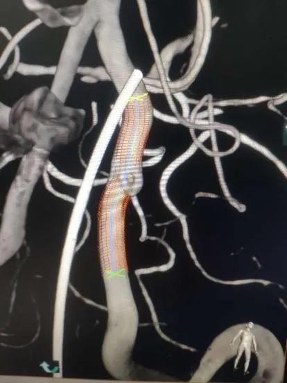 淄博市中心医院治疗动脉瘤,tubridge动脉瘤支架医保报销多少