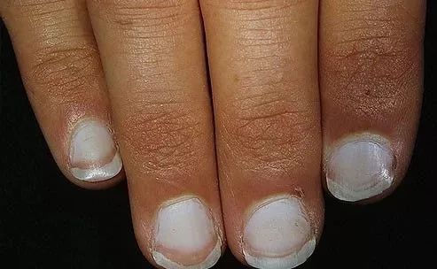 娃指甲上有白点是怎么回事,孩子指甲横纹有白点