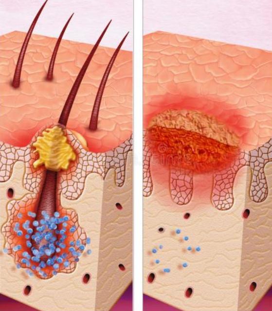 为啥粉刺挤了好得快,粉刺挤完长得更多怎么回事