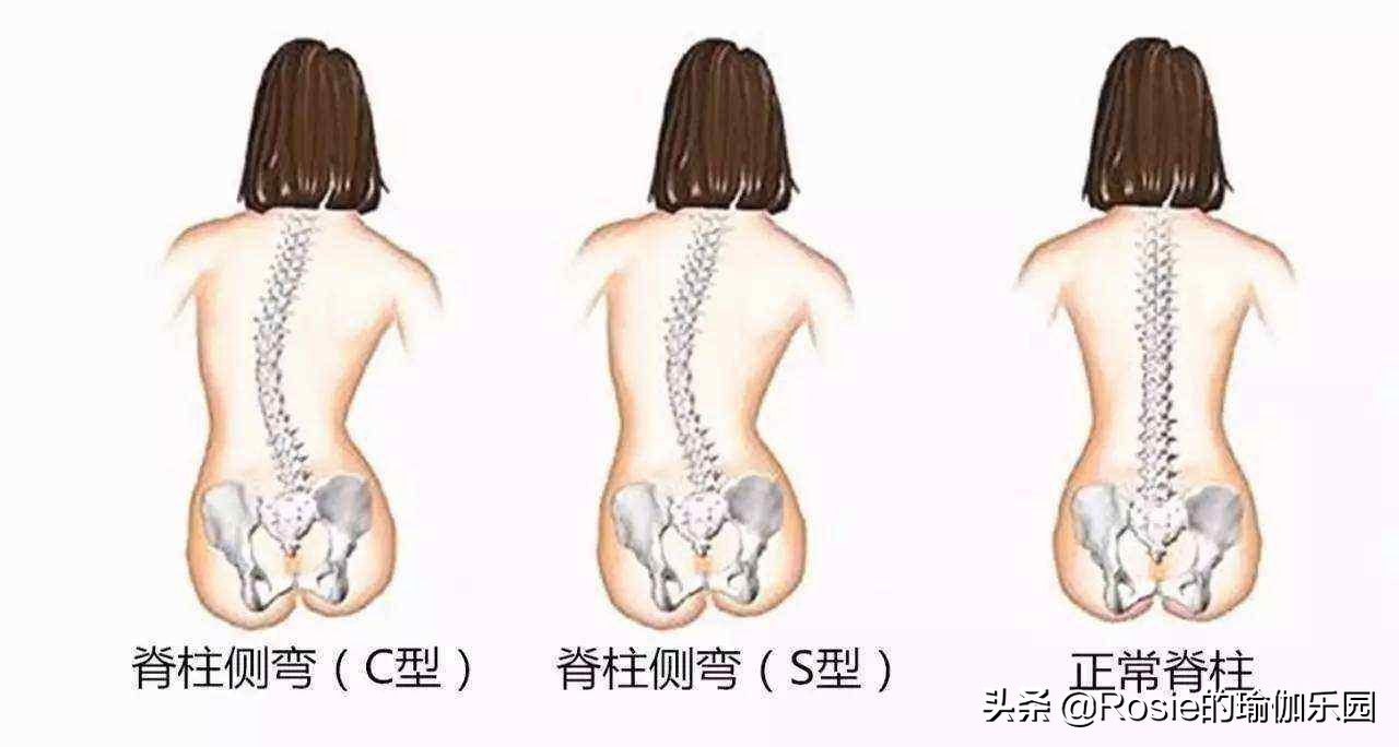 长短腿高低肩驼背头前倾,怎样改善高低肩和驼背学生