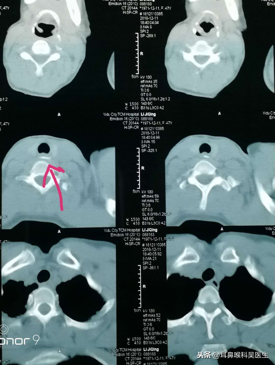 气管卡住异物怎样排出,被异物卡住喉咙该怎么办