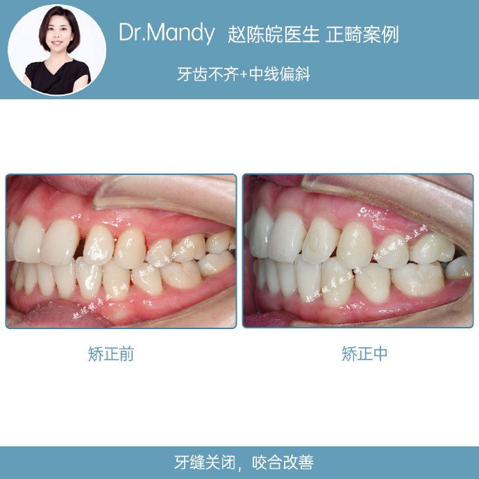 正畸牙齿不齐案例,牙齿拥挤正畸真实案例