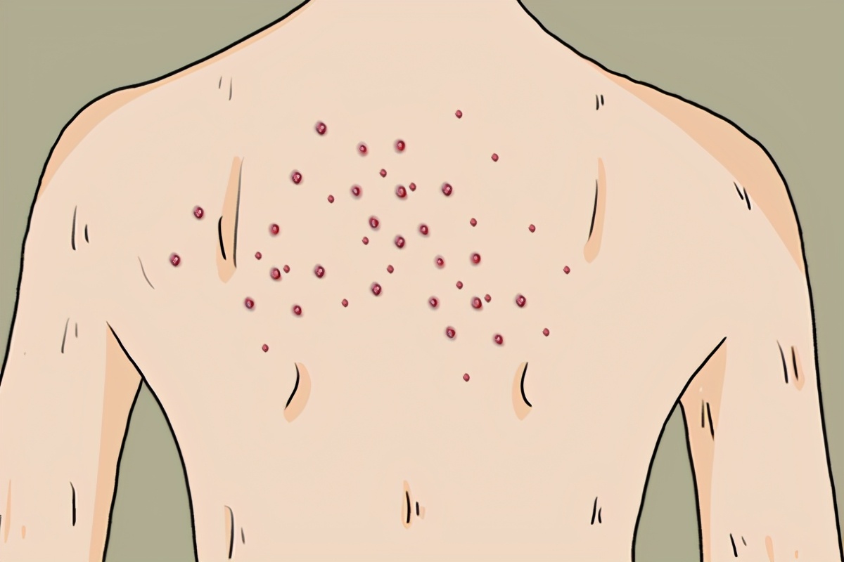 头皮和后背起疙瘩瘙痒是怎么回事,头皮上有个小疙瘩抠掉还会长