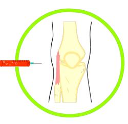 上楼梯出现疼痛、弹响，走平路却跟没事儿一样，很可能是软骨磨损