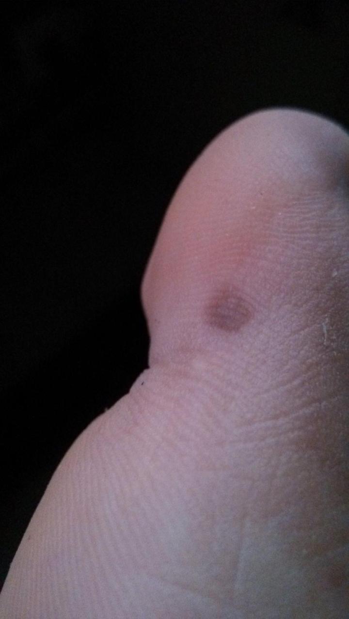 路边摆摊点痣用什么点痣,路边点痣和正规医院点痣区别