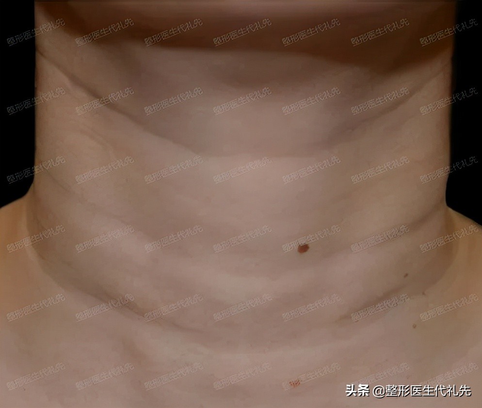咨询医生怎样去除皱纹,医生讲颈纹怎么消除的小妙招