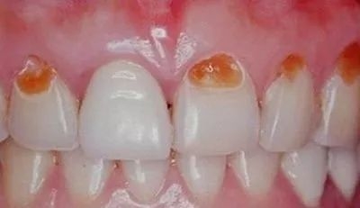 婴儿牙齿脱矿的原因有哪些,牙齿脱矿什么原因