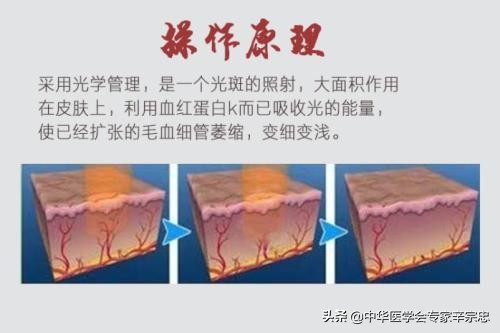 激光一年后眼睛红有血丝什么情况,做完激光脸红有血丝