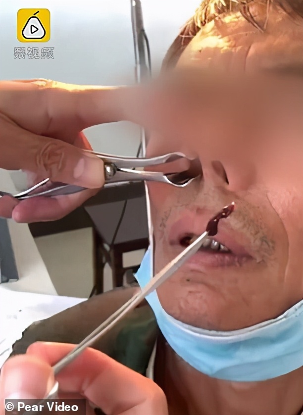 男孩被蚂蚁吓死,蚂蝗寄生在五岁男孩身体里一年