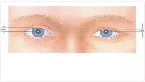 上了年纪眼皮耷拉眼困怎么回事,眼皮耷拉犯困怎么回事