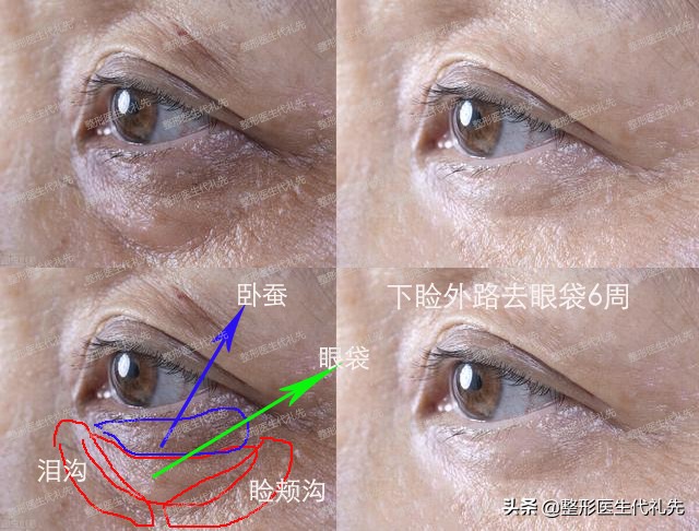祛眼袋十问十答,提眉祛眼袋泪沟脂肪填充后