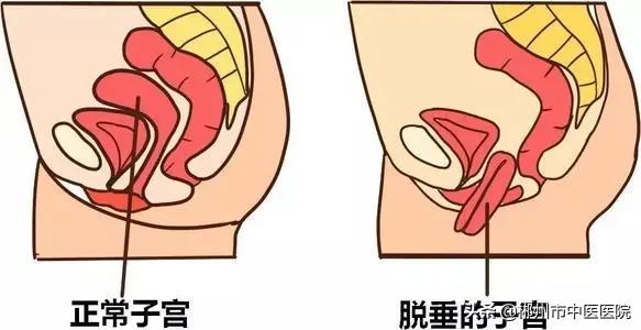 43岁二胎后盆底修复,盆底肌没有修复就怀上二胎