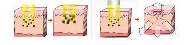 激光美白祛斑淡化斑点并去除皱纹,牙齿内源性变色用激光美白有用吗