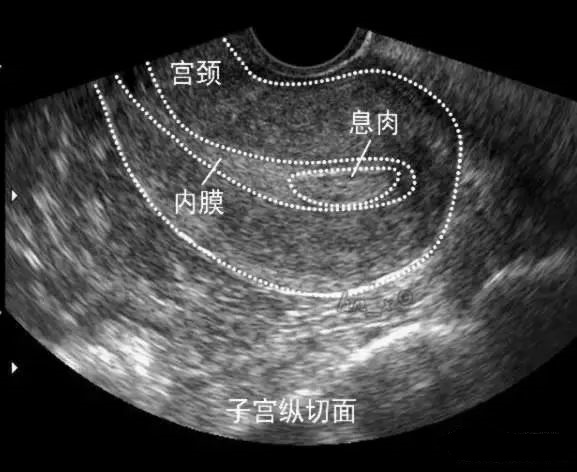 B超检查“子宫内膜回声不均”，我到底得了什么病？