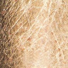 鱼鳞病分类及症状,鱼鳞病怎么区分类型