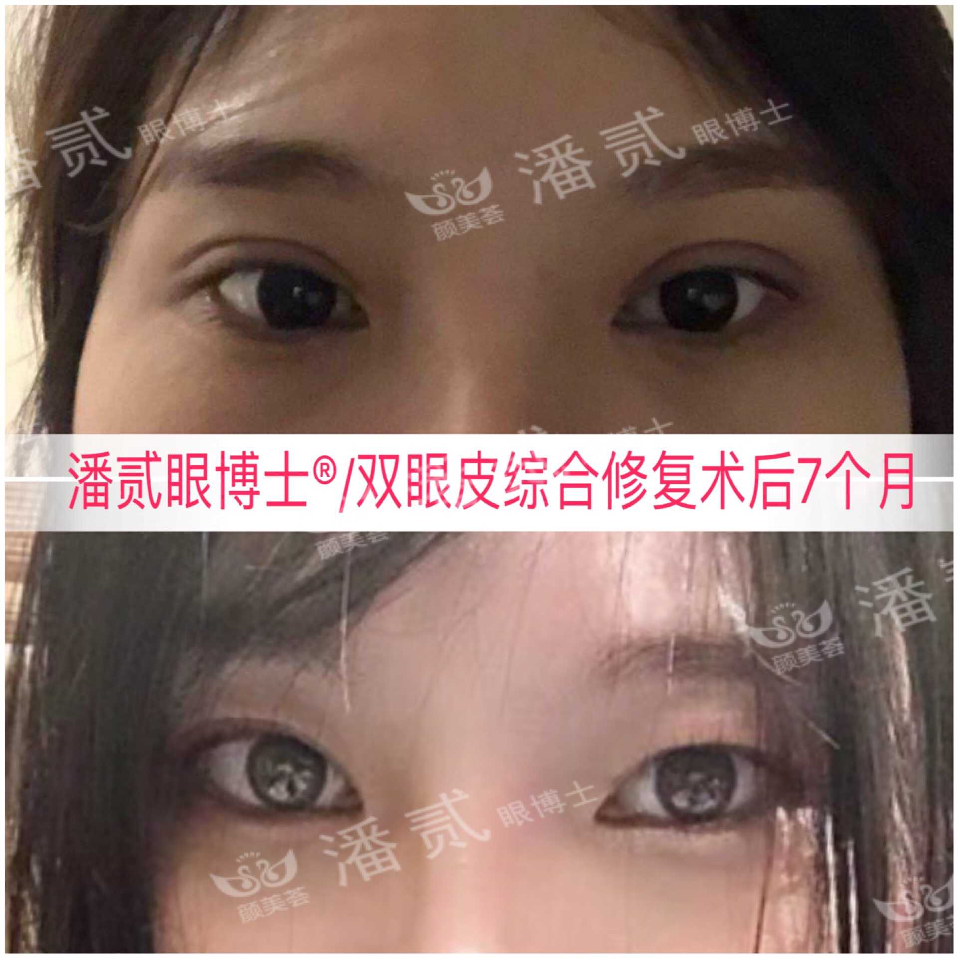 眼角下垂做双眼皮手术可以改变吗,后悔做双眼皮