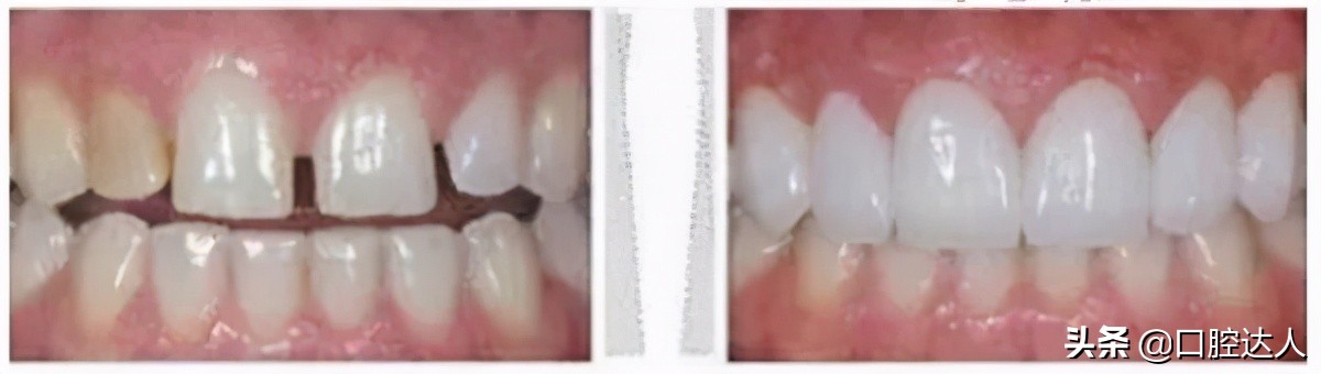 牙缝大是牙冠矫正还是贴面,牙齿贴面补牙缝多少钱