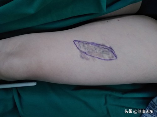 纹身需慎重身体伤害大祛除很苦恼