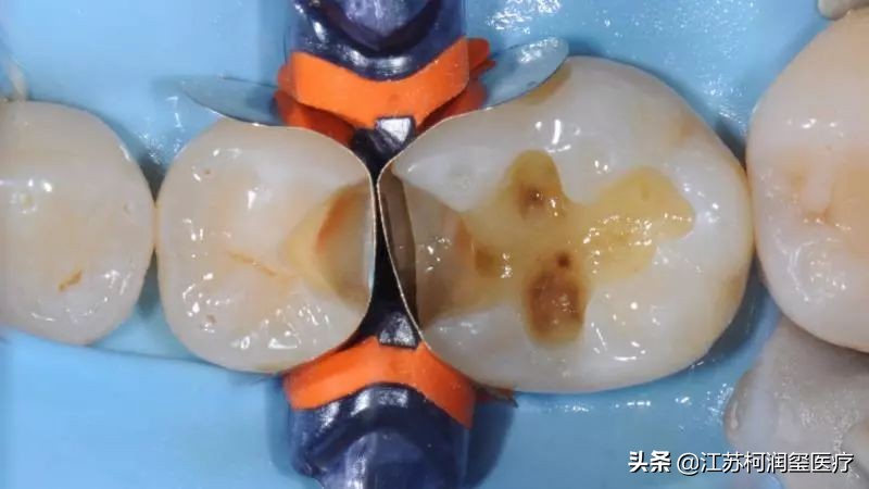 种植牙需要注意避开哪些坑,种植牙怎么选择适合自己的