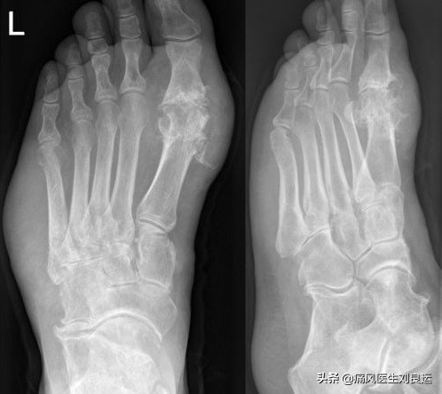 痛风是遗传因素大还是后天因素大,痛风是不是有遗传的因素呀