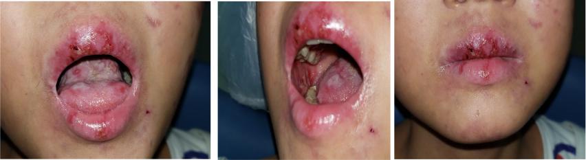 白血病骨髓移植口腔溃疡,骨髓移植后口腔溃疡怎么好得快