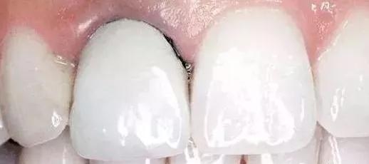 烤瓷牙可以解决牙齿不齐问题吗,烤瓷牙能修复吗