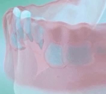 小孩乳牙没有掉要去医院拔牙,恒牙出来多久了乳牙未掉需要拔牙