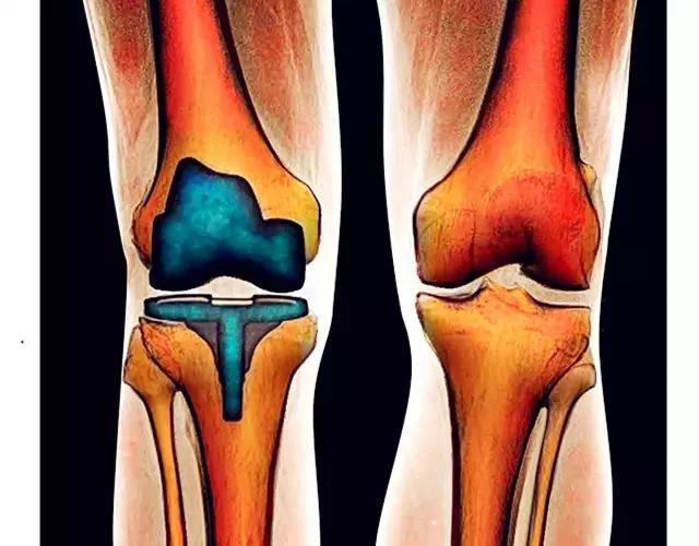 膝关节置管术和膝关节置换修补术,膝关节置换与全膝关节置换的区别