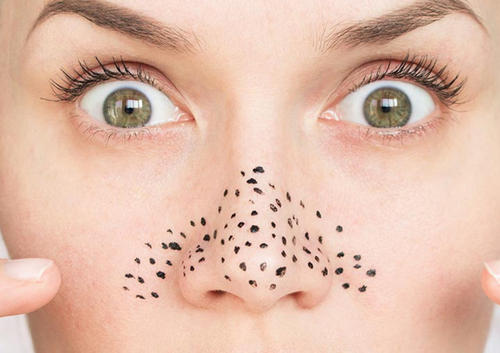 脸上的黑头粉刺该不该挤出来,青少年脸上黑头粉刺如何去除