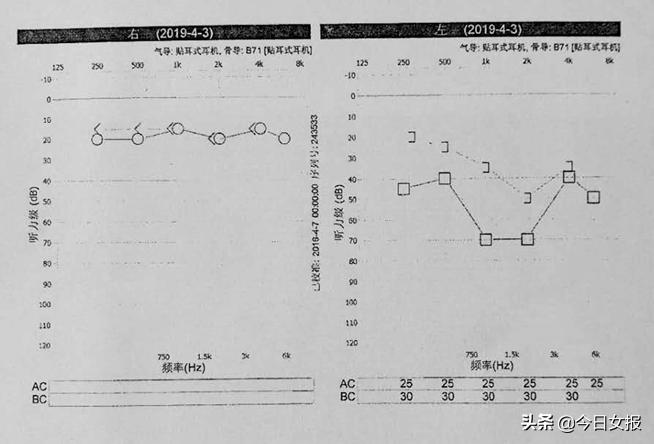 掏耳朵掏破耳膜要紧吗,牙签掏耳朵掏到鼓膜