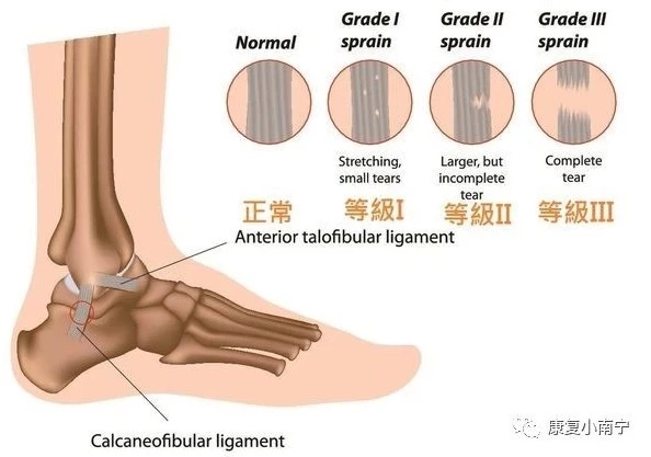 习惯性崴脚后康复训练,习惯性崴脚康复锻炼