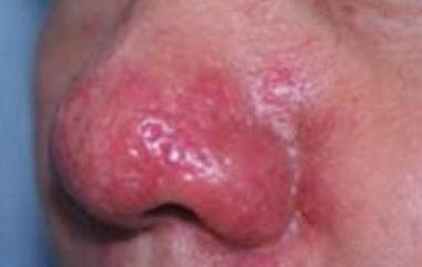 酒糟鼻如何应对,酒糟鼻是常见的美容病该如何应对