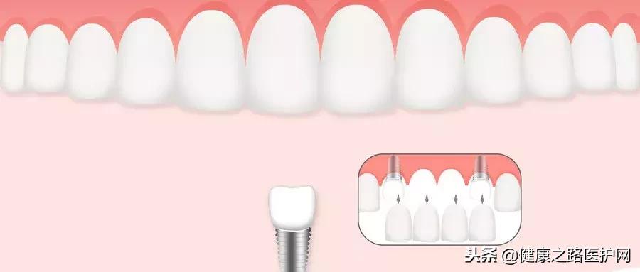 牙医告诉你不要随便做烤瓷牙,为什么医生都建议做烤瓷牙