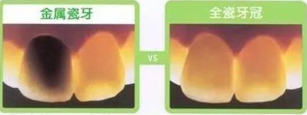 全烤瓷牙有什么风险和后遗症,做烤瓷牙有什么危害