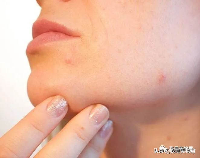 敏感肌最好的祛闭口神器,去闭口的最佳方法敏感肌