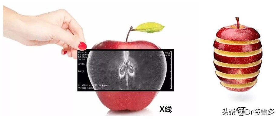 怀孕初期照了x光有影响吗,照了手部x光当月怀孕了有影响吗