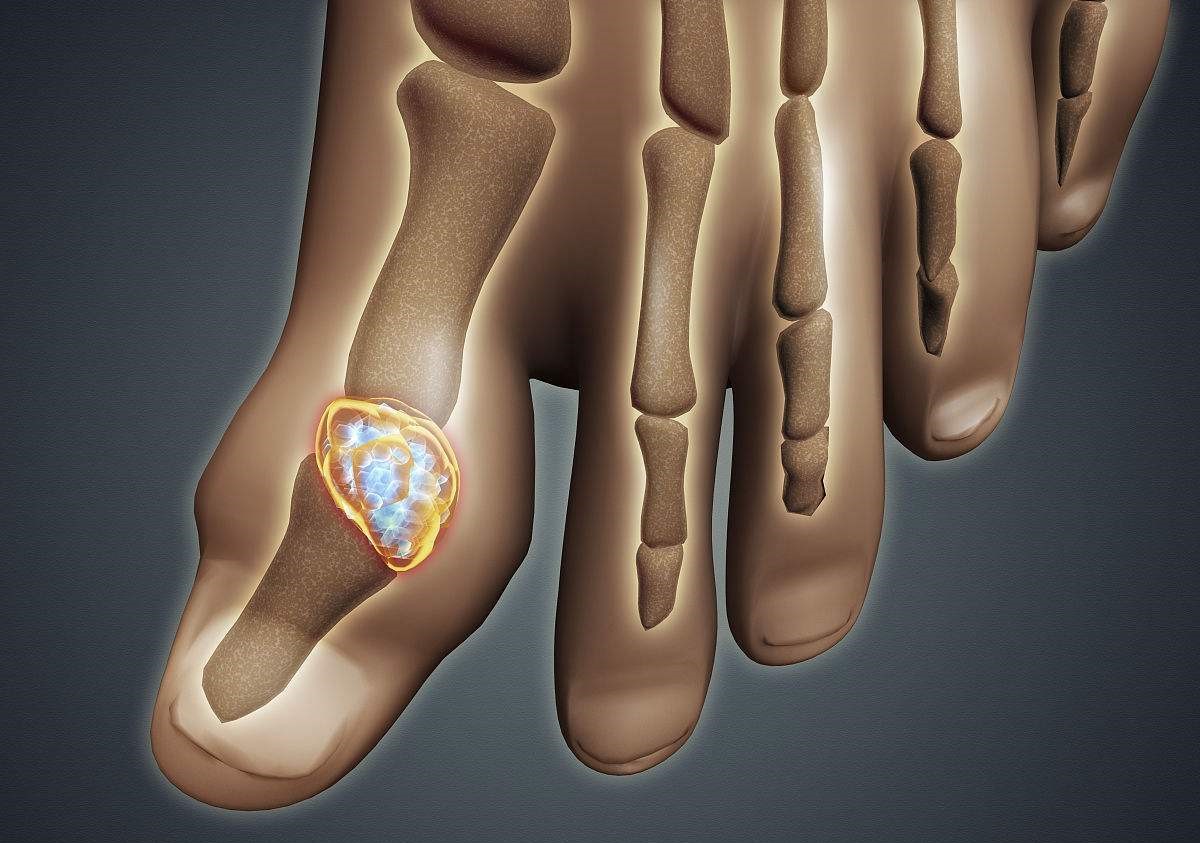 辟谣痛风喝酒,痛风辟谣