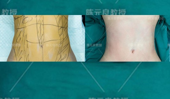 去做吸脂手术都咋想的,想抽脂需要了解的事项