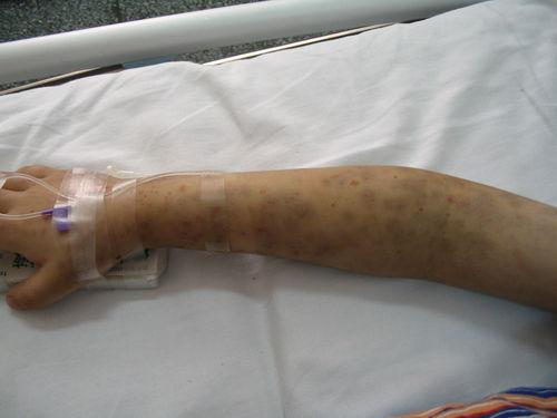 皮肤无缘无故出现青紫淤斑,身上出现淤青紫色斑点是什么病