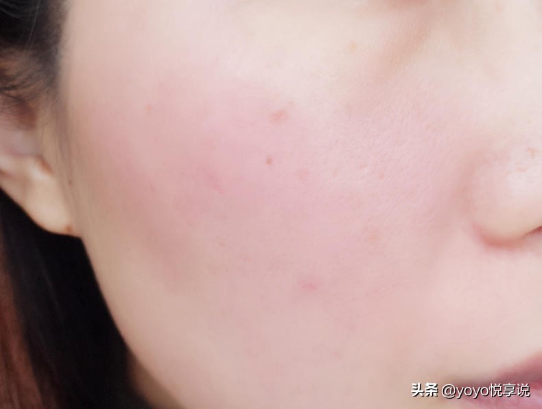 冬季脸上泛红敏感肌应该抹什么,换季春季脸干燥脱皮紧绷刺痛水乳