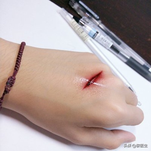 耳朵受伤需要打破伤风吗,受伤后一定要打破伤风么